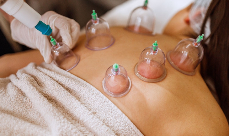 Cupping Therapy