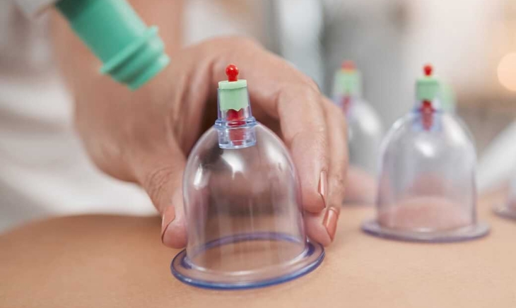 Cupping Therapy