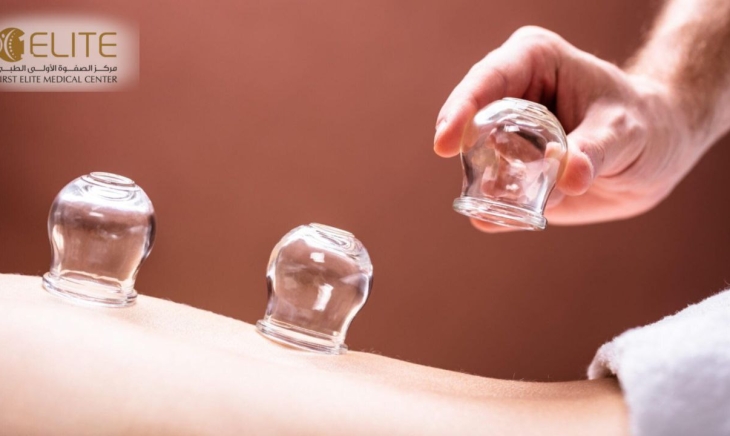 دور الحجامة في ضعف الانتصاب: ما الذي نعرفه؟